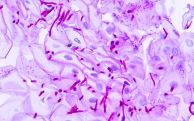 CANDIDIASI VAGINAL