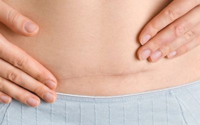 Fisioterapia para la cicatriz de cesárea en Barcelona: cuidado, tratamiento y prevención de molestias