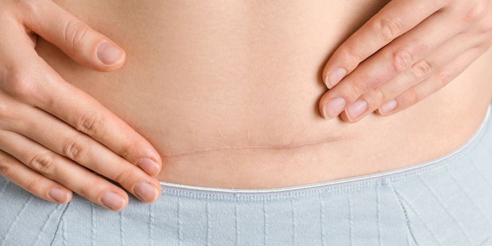 Fisioterapia para la cicatriz de cesárea en Barcelona: cuidado, tratamiento y prevención de molestias